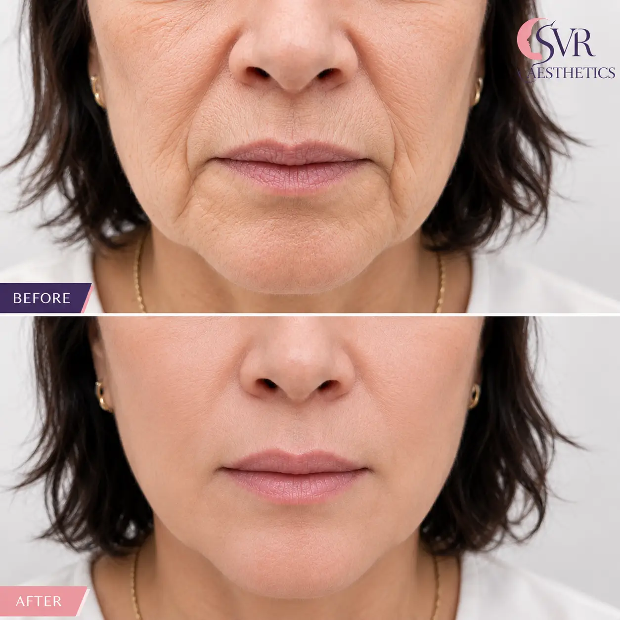 Cheek Augments Treatment in Milton Keynes